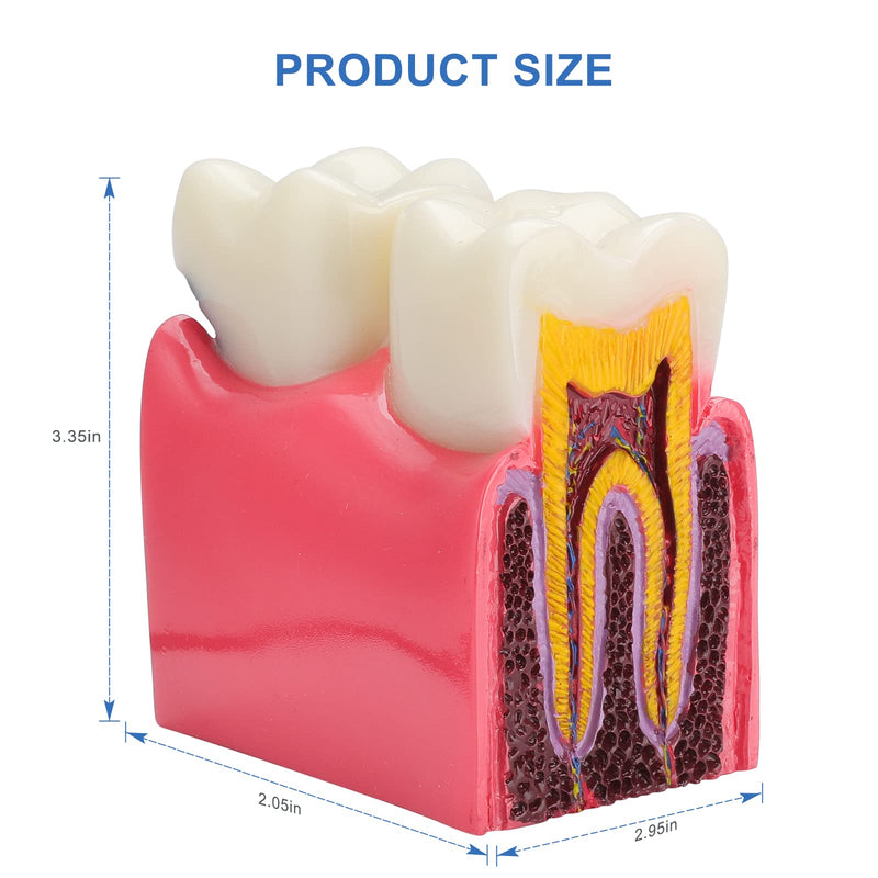 [Australia - AusPower] - Dental Caries Tooth Model - 6 Times Tooth Decay Model Dental Models for Patient Education Root Canal Model Tooth Model for Teaching Kids 