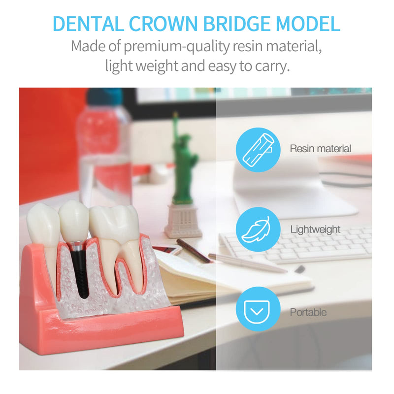 [Australia - AusPower] - ANNWAN Dental Implant Model 4 Times Removable Analysis Crown Bridge Demonstration Teeth Model for Class Education and Studying Teeth Model 