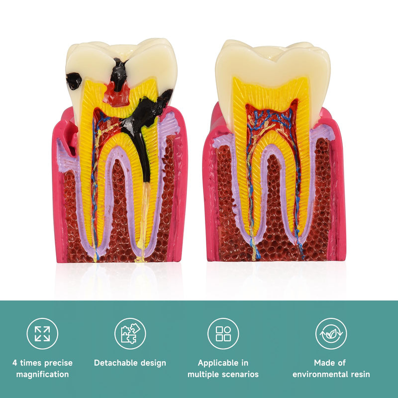 [Australia - AusPower] - Dental Tooth Decay Model 6 Times Dental Caries Teeth Model Caries Bilateral Comparison Pathology Model Teeth for Dental Education Supplies, Tooth Pathology Display 