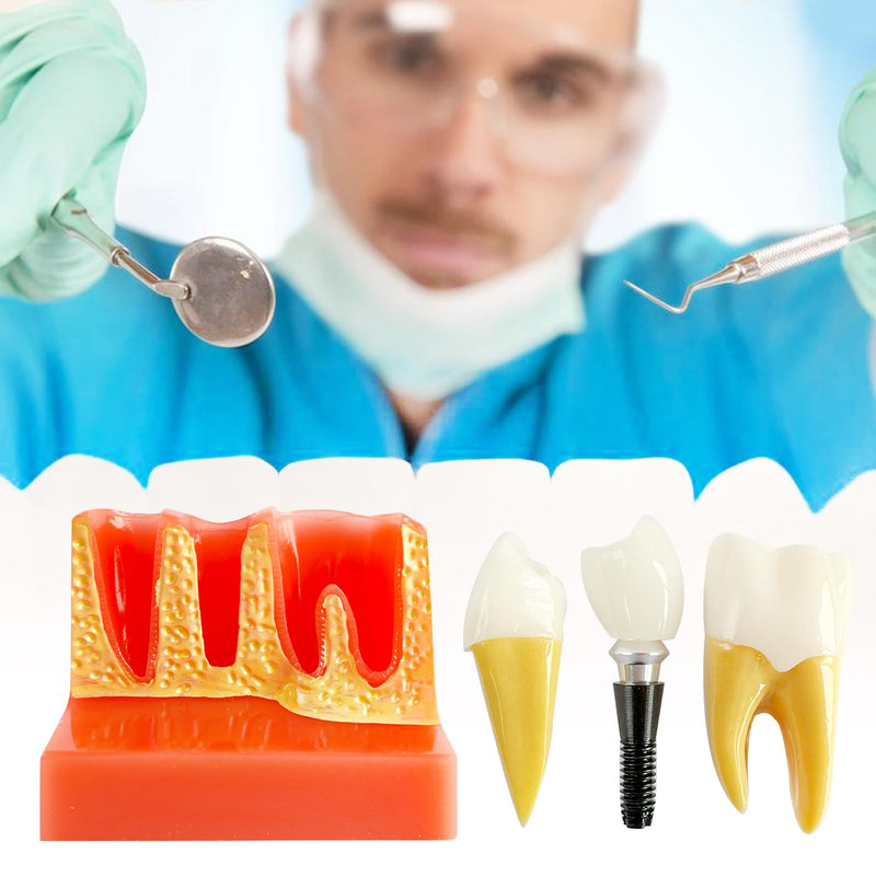 [Australia - AusPower] - Dental Implant Model with Removable Crown Bridge - 4 Times Enlarged Demonstrative Teeth Model for Education and Study - Ideal for Class Demonstrations and Dental Student Training 