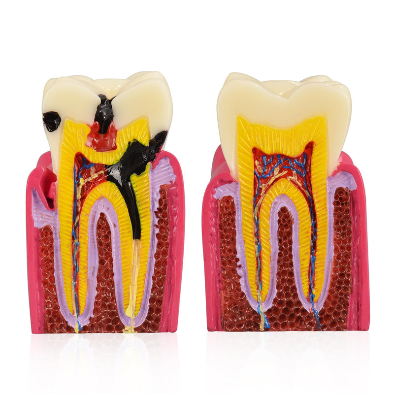 [Australia - AusPower] - Dental Tooth Decay Model 6 Times Dental Caries Teeth Model Caries Bilateral Comparison Pathology Model Teeth for Dental Education Supplies, Tooth Pathology Display 