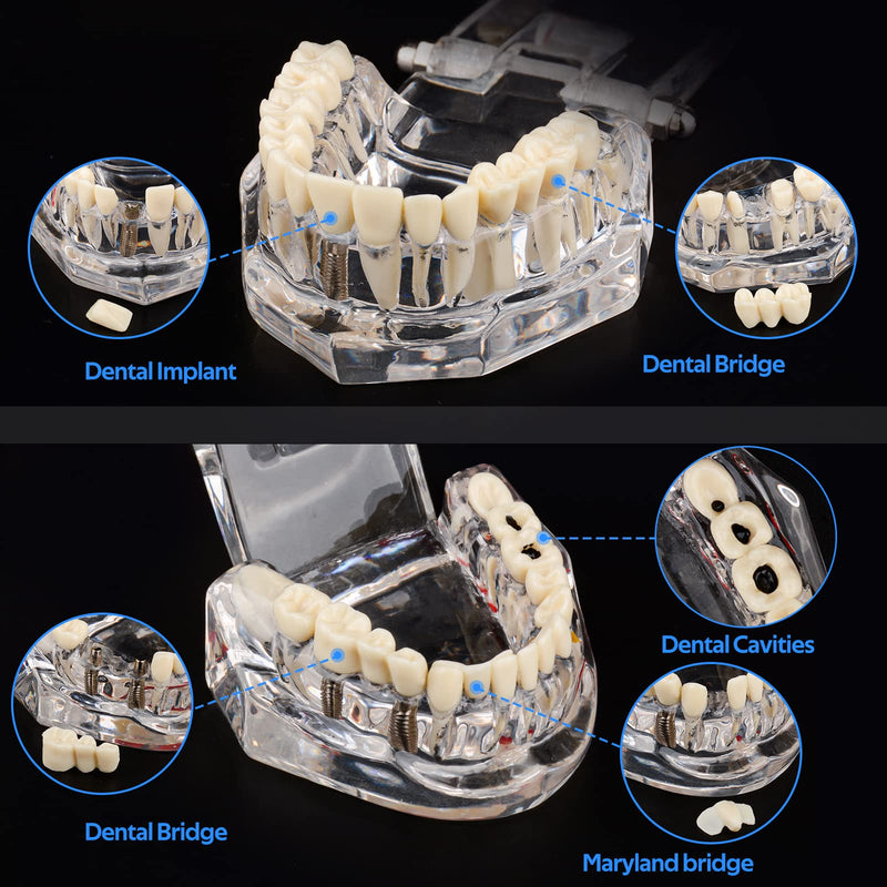 [Australia - AusPower] - Transparent Disease Teeth Model with Dental Implant Bridge, Dental Model for Patient and Dental Student Education 