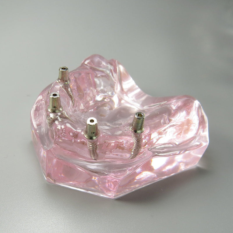 Dental Model Overdenture Upper Teeth 4 Implants Demo for Teaching and Studying