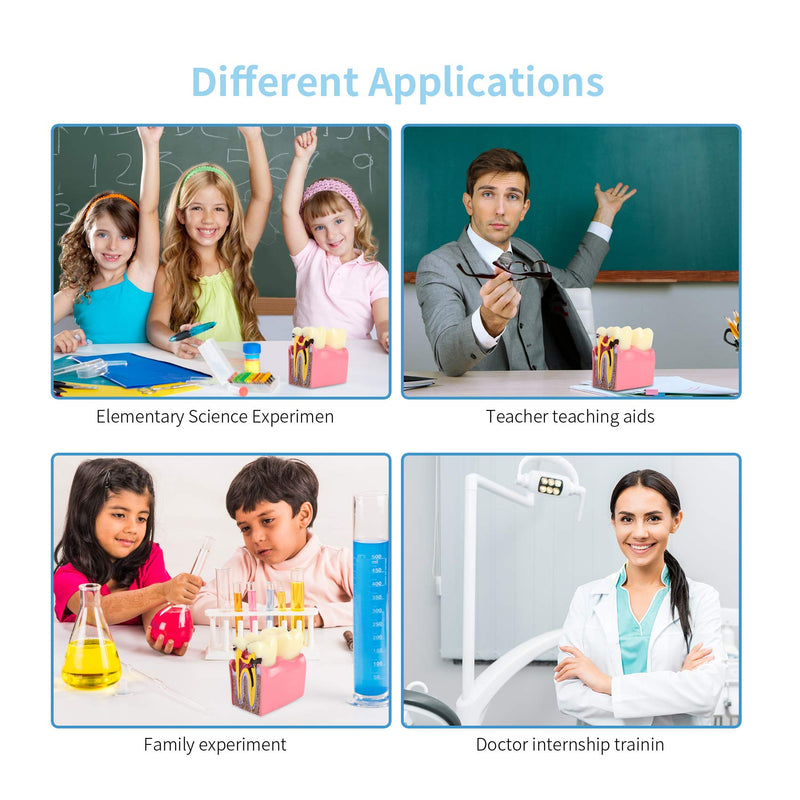 Dental Caries Tooth Model 6 Times Decay Teeth Comparative Study Model, Caries Bilateral Comparison Pathology Teeth Model Teaching Learning Tools for Dentist, Patient Education and Explanation