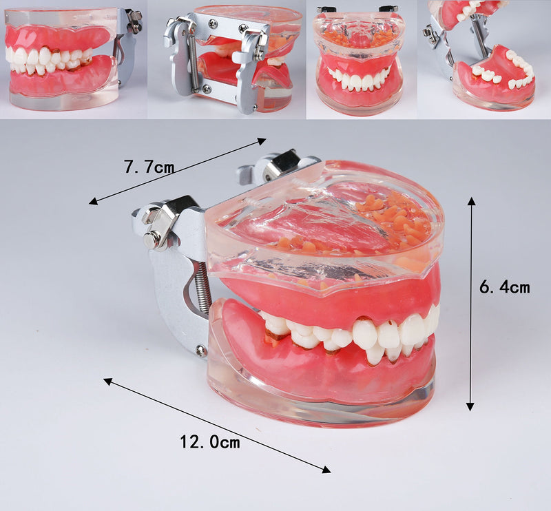 [Australia - AusPower] - Dental Teeth Typodonts Model for Parodontopathy Periodontal Disease, Removable Gingivae Pathology Teeth Model Used in Teaching,Explain,Studying for Adult(Transparent) 