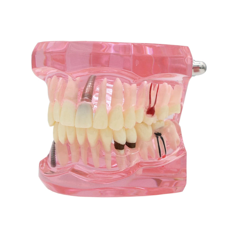 [Australia - AusPower] - Teeth Model Teeth Typodonts Dental Implant Study Analysis Demonstration Teeth Model #2001 with Restoration Pink 