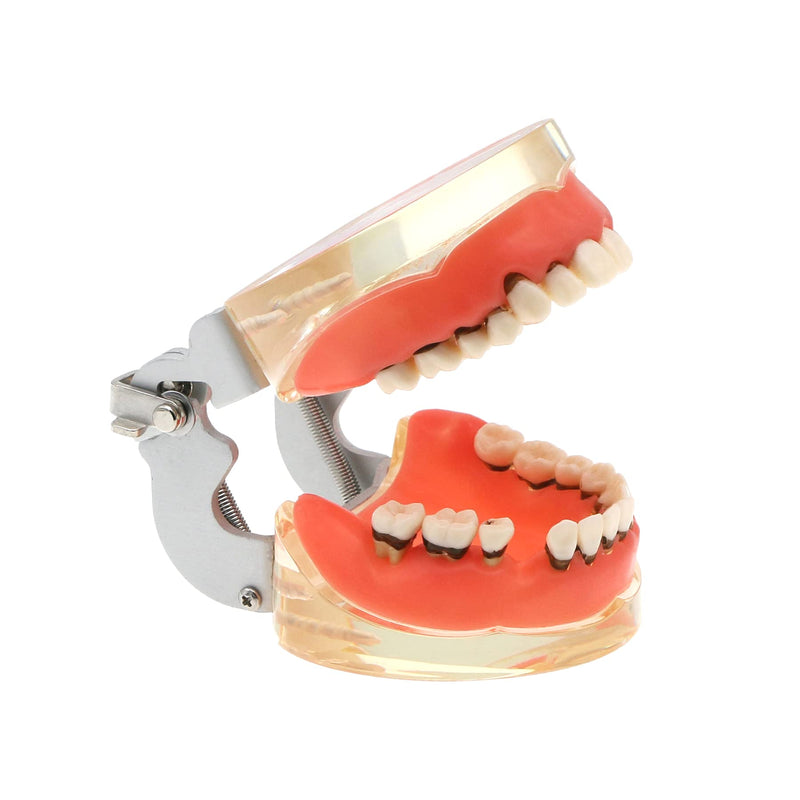 [Australia - AusPower] - Dental Teeth Typodonts Model for Parodontopathy Periodontal Disease, Removable Gingivae Pathology Teeth Model Used in Teaching,Explain,Studying for Adult(Transparent) 