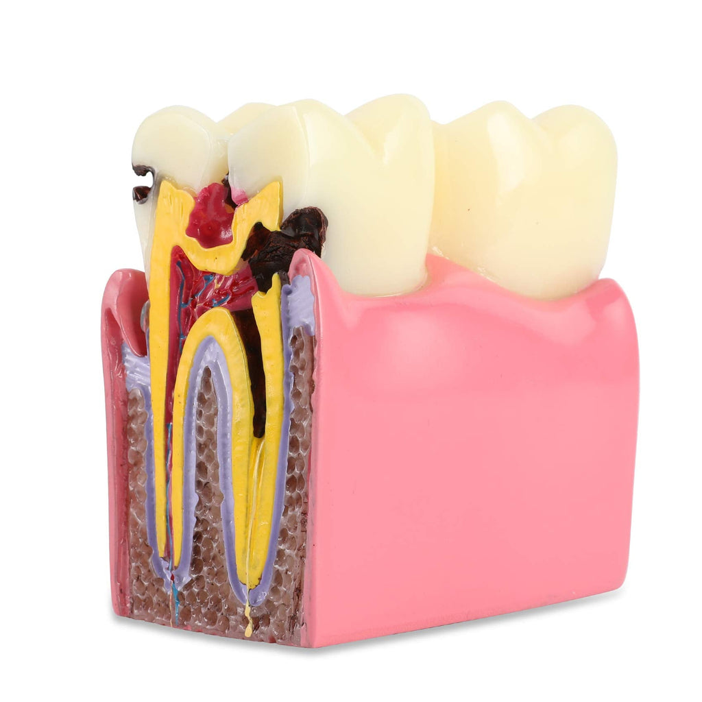 Dental Caries Tooth Model 6 Times Decay Teeth Comparative Study Model, Caries Bilateral Comparison Pathology Teeth Model Teaching Learning Tools for Dentist, Patient Education and Explanation