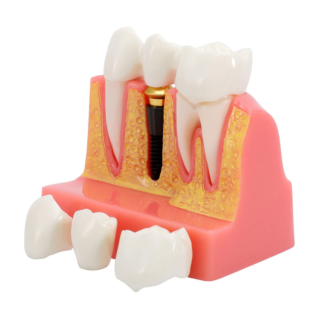 Annhua 4 Times Dental Implant Teeth Model Analysis Crown Bridge Demonstration Model, Dental Teeth Crown Roots Removable for Education, Patients Communication, Learning and Lab