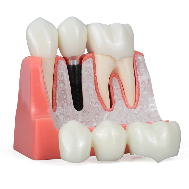 [Australia - AusPower] - ANNWAN Dental Implant Model 4 Times Removable Analysis Crown Bridge Demonstration Teeth Model for Class Education and Studying Teeth Model 