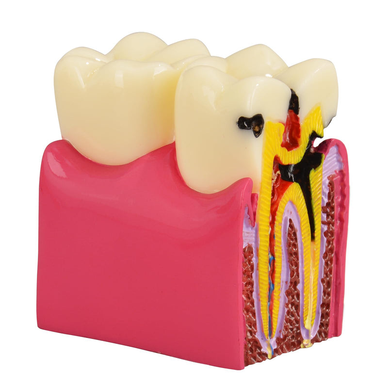 [Australia - AusPower] - Dental Tooth Decay Model 6 Times Dental Caries Teeth Model Caries Bilateral Comparison Pathology Model Teeth for Dental Education Supplies, Tooth Pathology Display 