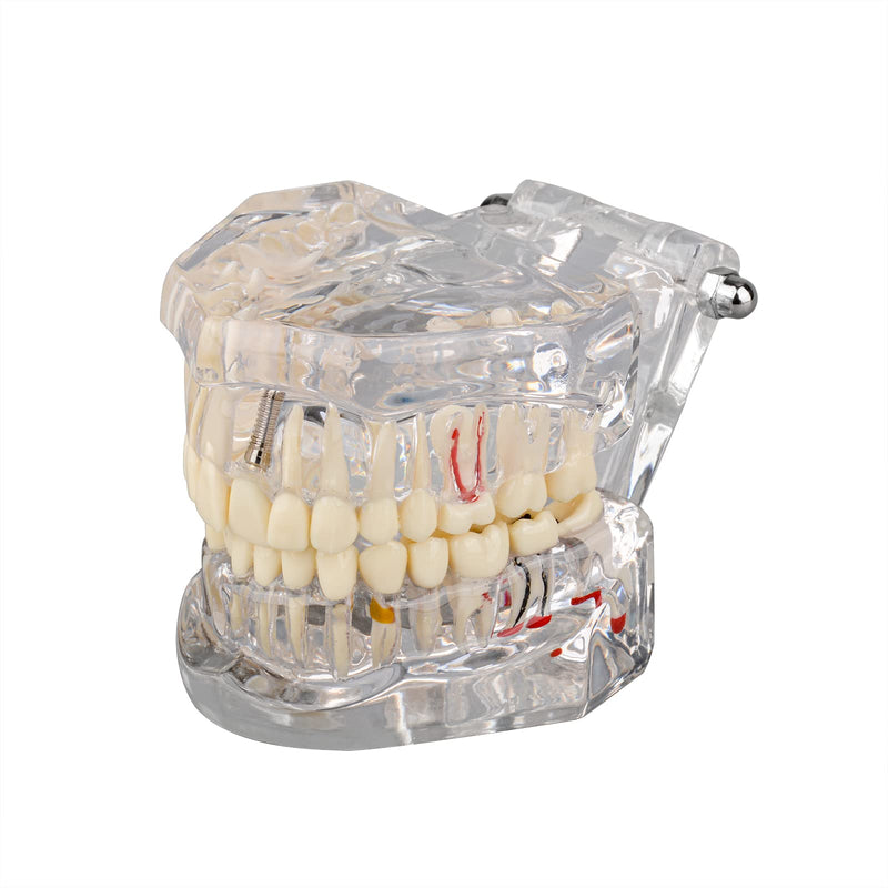 [Australia - AusPower] - Transparent Disease Teeth Model with Dental Implant Bridge, Dental Model for Patient and Dental Student Education 