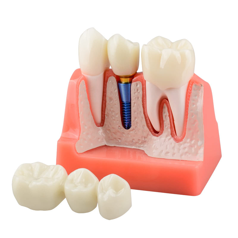 [Australia - AusPower] - Dental Implant Model for Patient Education, 4 Times Dental Implant, Crown and Bridge Model for Presentation-Pink 