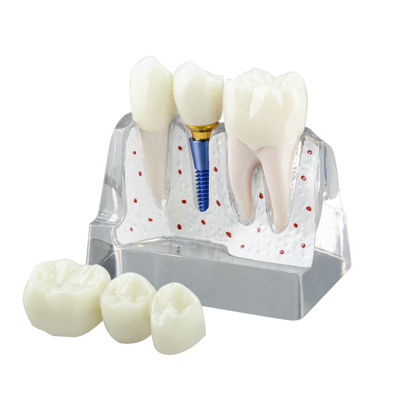 [Australia - AusPower] - Dental Implant Model for Patient Education, 4 Times Dental Implant, Crown and Bridge Model for Presentation-Transparent 
