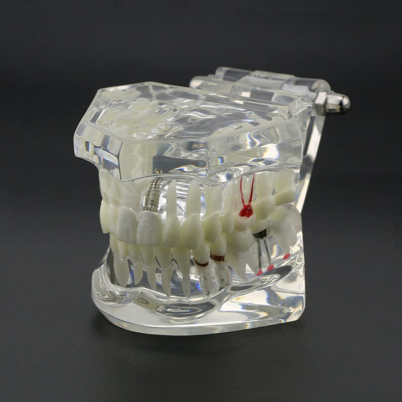 Dental Typodont Implant Restoration Model Dental Pathology Teaching Demonstration Simulation Model (Transparent Clear) Transparent Clear