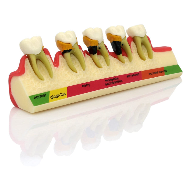 [Australia - AusPower] - Teeth Periodontal Disease Model Dental Caries Breakdown Display Periodontitis Show Teaching Tooth Model Dentist Odontologia Communication 