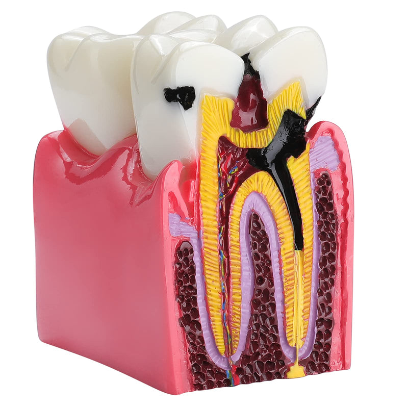 [Australia - AusPower] - Dental Caries Tooth Model - 6 Times Tooth Decay Model Dental Models for Patient Education Root Canal Model Tooth Model for Teaching Kids 
