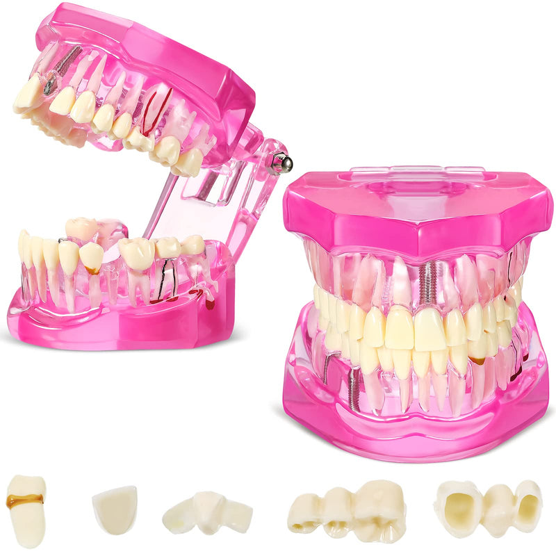 Outus Disease Teeth Model Dental Implant Typodont with Removable Tooth Dentist Standard Tooth Pathological Demonstration for Back to School Education Dental Supplies(Pink,2 Pcs) 2 Pink