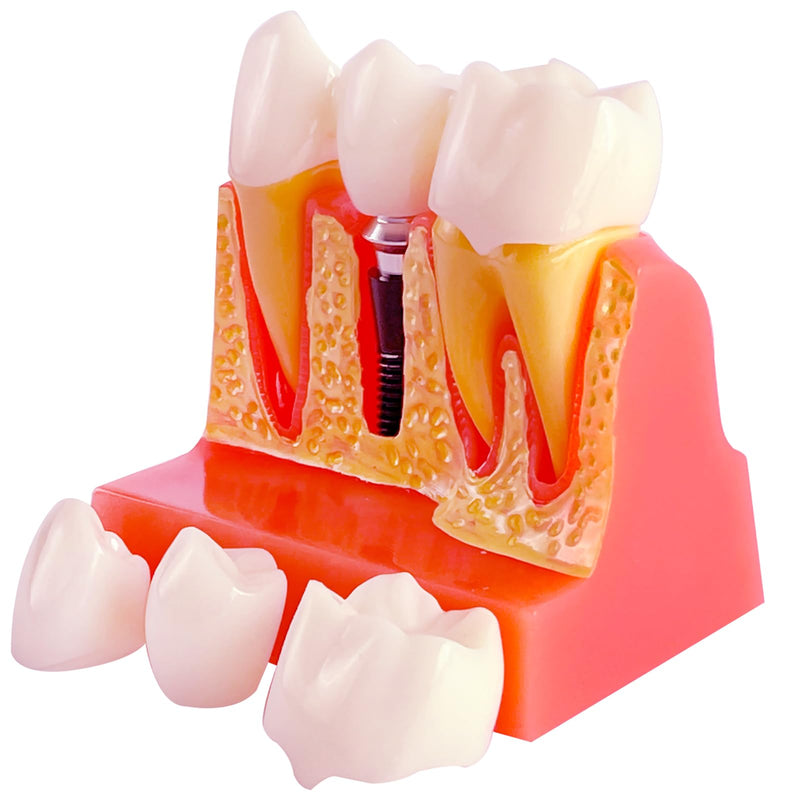 [Australia - AusPower] - Dental Implant Model with Removable Crown Bridge - 4 Times Enlarged Demonstrative Teeth Model for Education and Study - Ideal for Class Demonstrations and Dental Student Training 