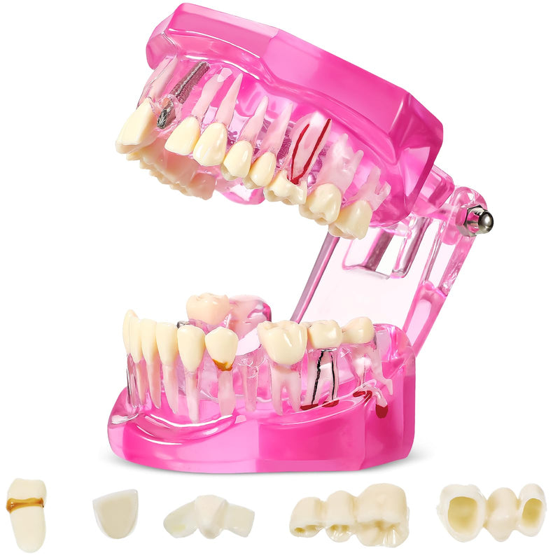 Outus Disease Teeth Model Dental Typodonts Implant Teeth Model with Removable Teeth Dentist Standard Tooth Pathological Demonstration for Christmas Education Dental Supplies (Pink,1 Pcs) 1 Pink