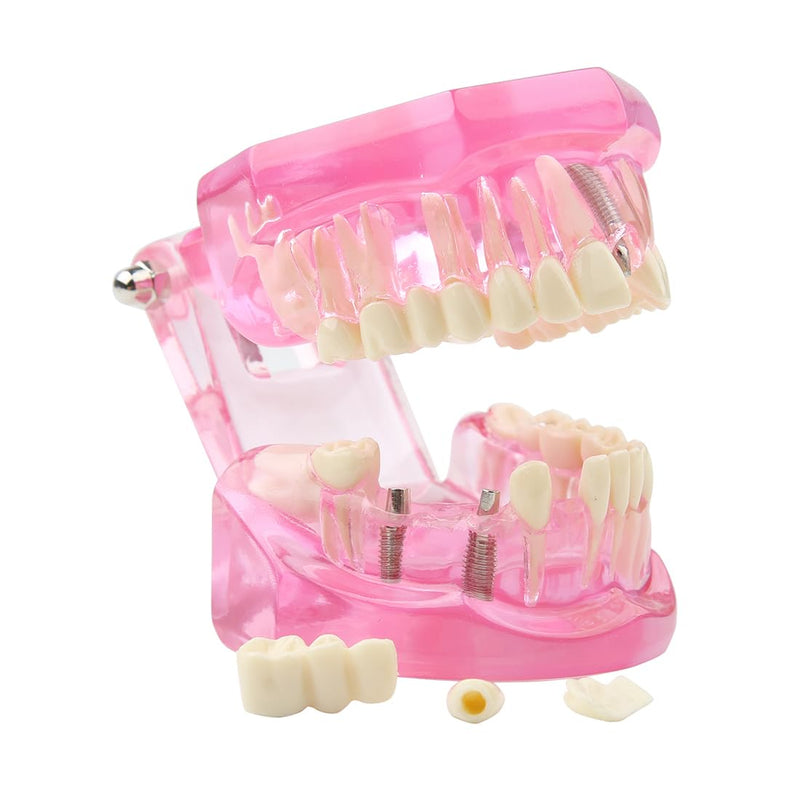 [Australia - AusPower] - Dental Transparent Disease Teeth Model lmplant Teeth Model Analysis Demonstration Standard Teeth Typodont Training Tooth Model with Removable Crown Bridge for Student Education (Pink） pink 