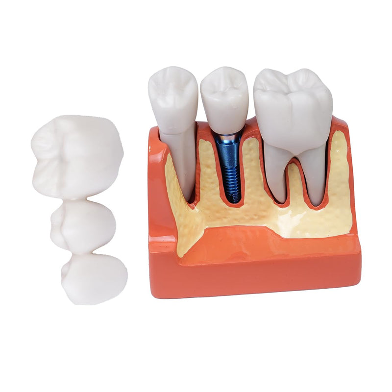 Sarini Oral Dental Model, Dental Implant Model with Removable Crown and Bridge, Suitable for Classroom Demonstrations and Dental Student Training