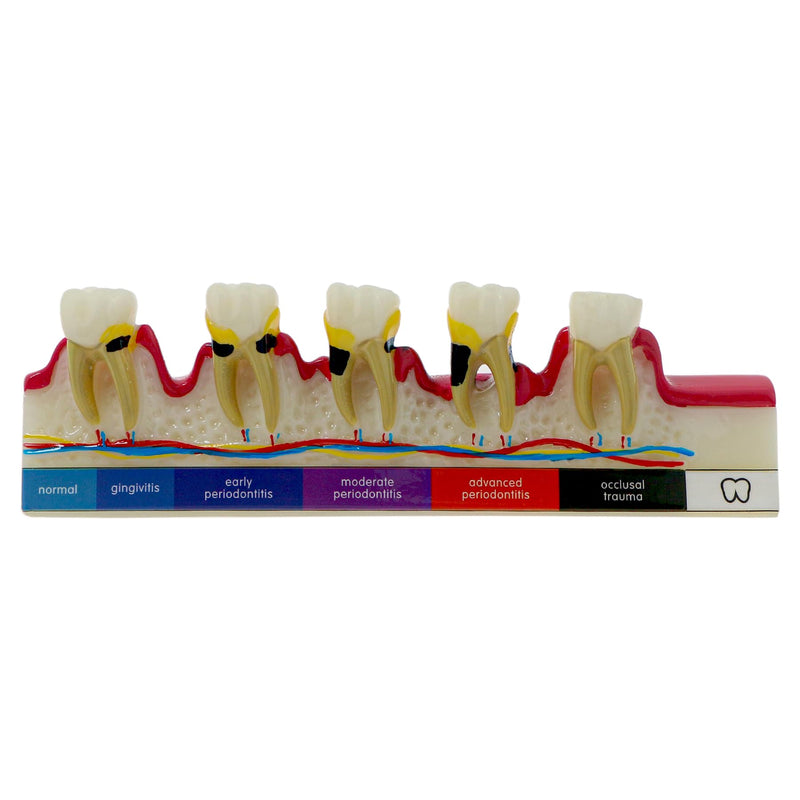 [Australia - AusPower] - Dental Teeth Model 6-Stage Periodontal Disease Demonstration Model for Dental Education 