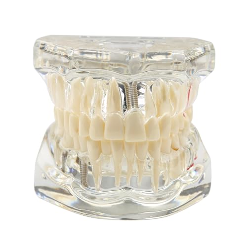 Tooth Model, Transparent Tooth Model with Removable Crown/Bridge, White | Implant dental model, orthodontic dental model, implant demo with removable crown/bridge for training