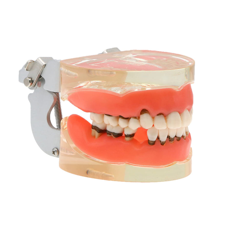 [Australia - AusPower] - Dental Teeth Typodonts Model for Parodontopathy Periodontal Disease, Removable Gingivae Pathology Teeth Model Used in Teaching,Explain,Studying for Adult(Transparent) 