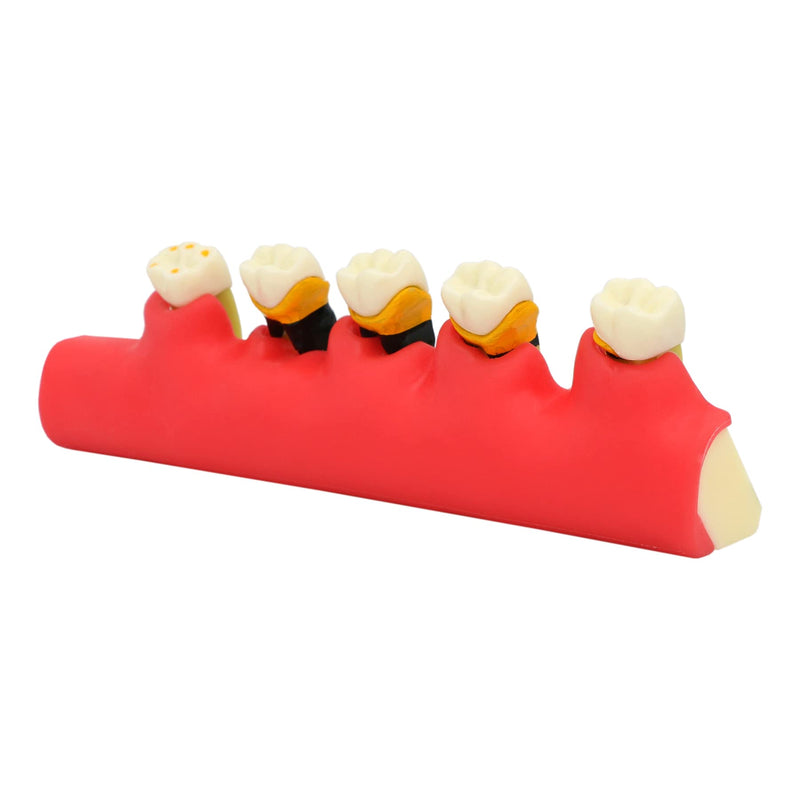 [Australia - AusPower] - Teeth Periodontal Disease Model Dental Caries Breakdown Display Periodontitis Show Teaching Tooth Model Dentist Odontologia Communication 