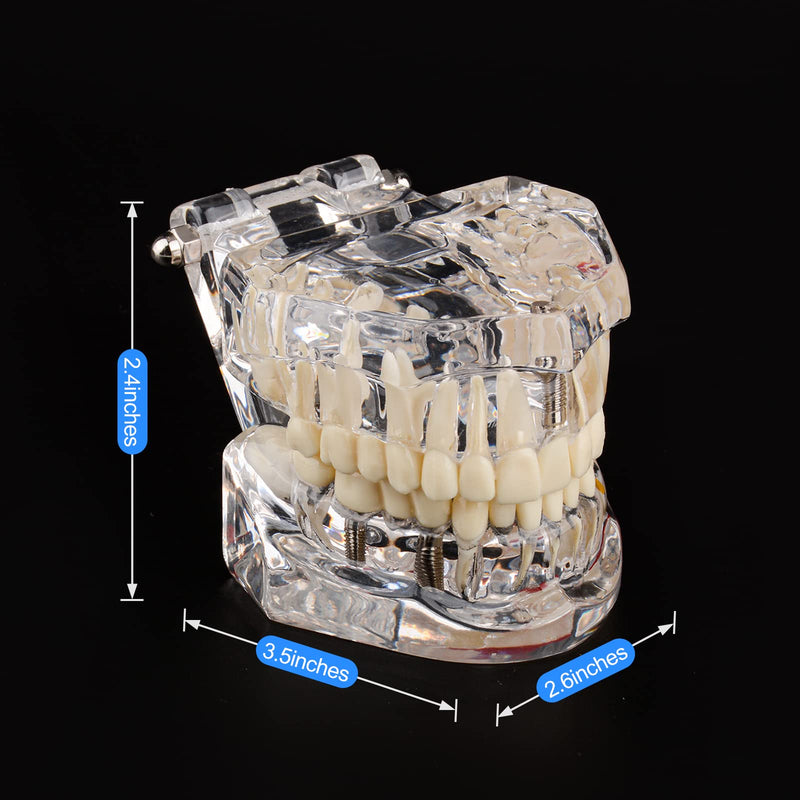[Australia - AusPower] - Transparent Disease Teeth Model with Dental Implant Bridge, Dental Model for Patient and Dental Student Education 