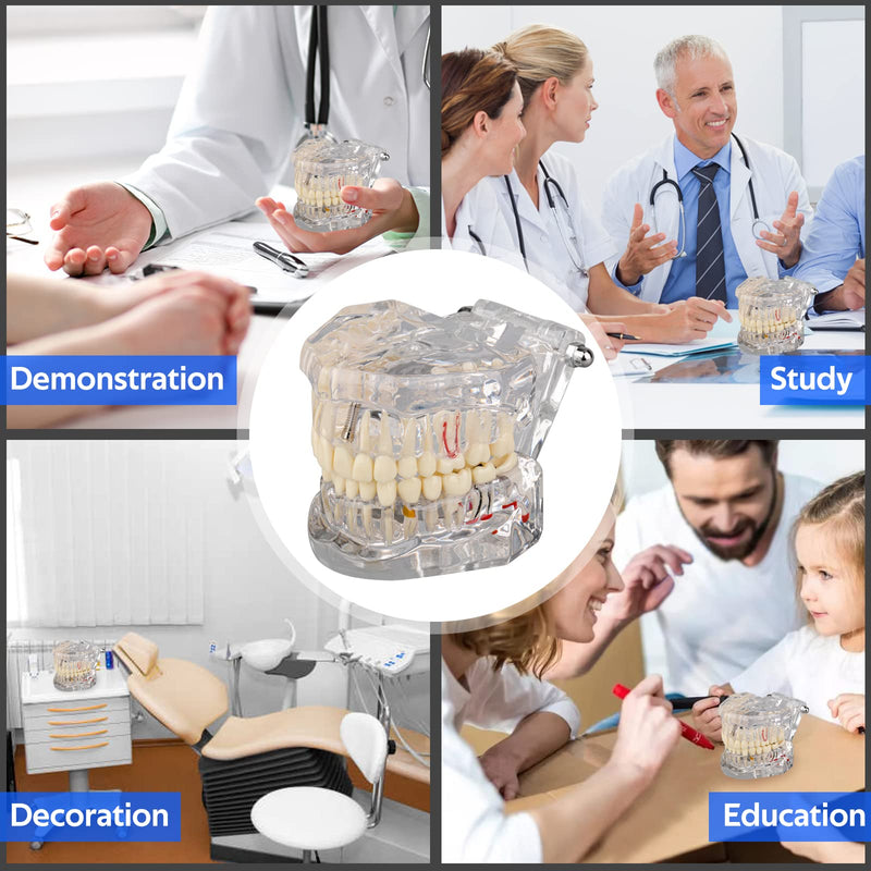 [Australia - AusPower] - Transparent Disease Teeth Model with Dental Implant Bridge, Dental Model for Patient and Dental Student Education 