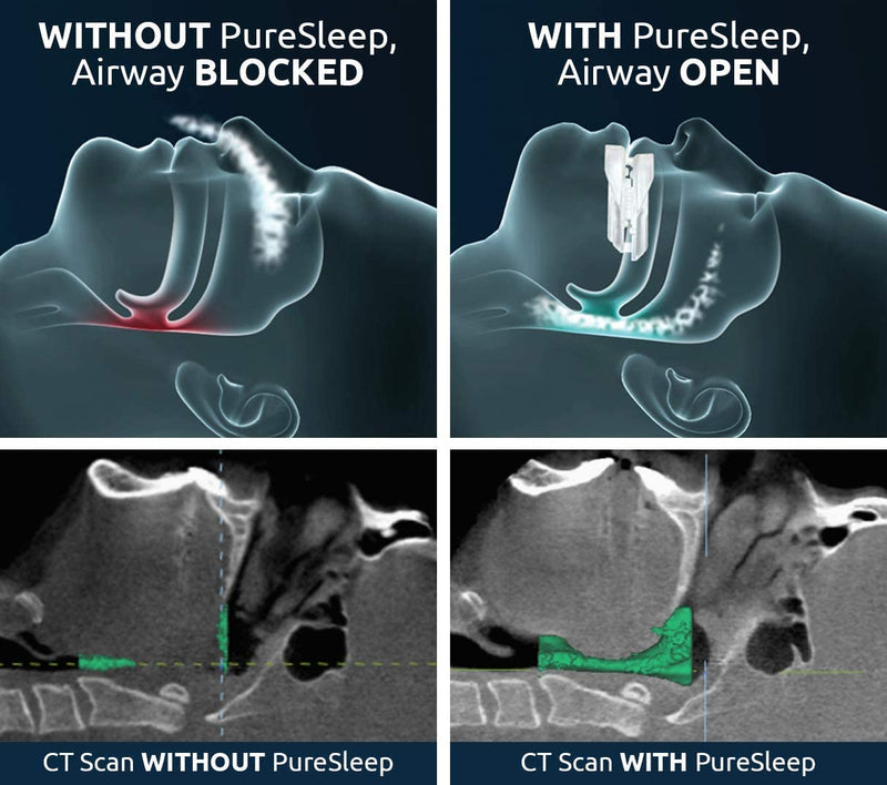 [Australia - AusPower] - PureSleep Anti-Snoring Mouthpiece – Helps Stop Snoring – The Original Anti-Snoring Solution – Comfortable & Adjustable – Over a Million Units Sold – Made in The USA 